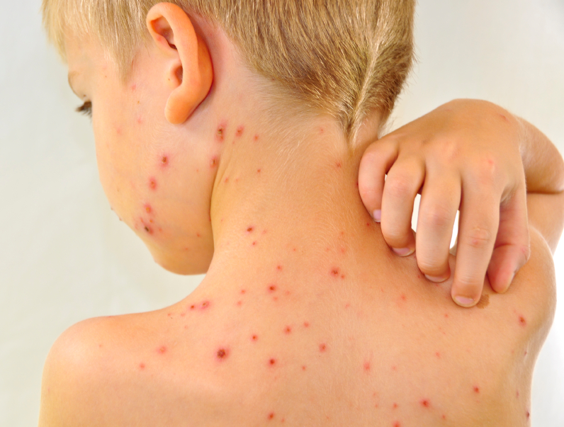 varicela niño marcas piel vacunatorio israel